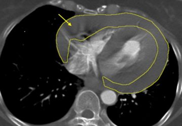 突發休克命懸一線　土城長庚醫療團隊72小時接力搶命成功