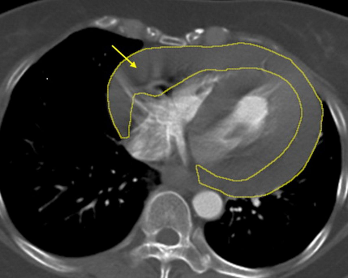 突發休克命懸一線　土城長庚醫療團隊72小時接力搶命成功